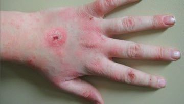 Man catches Tsutsugamushi Disease when fishing: SSM