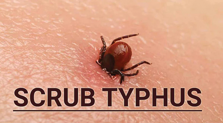 3rd case of scrub typhus found on Friday
