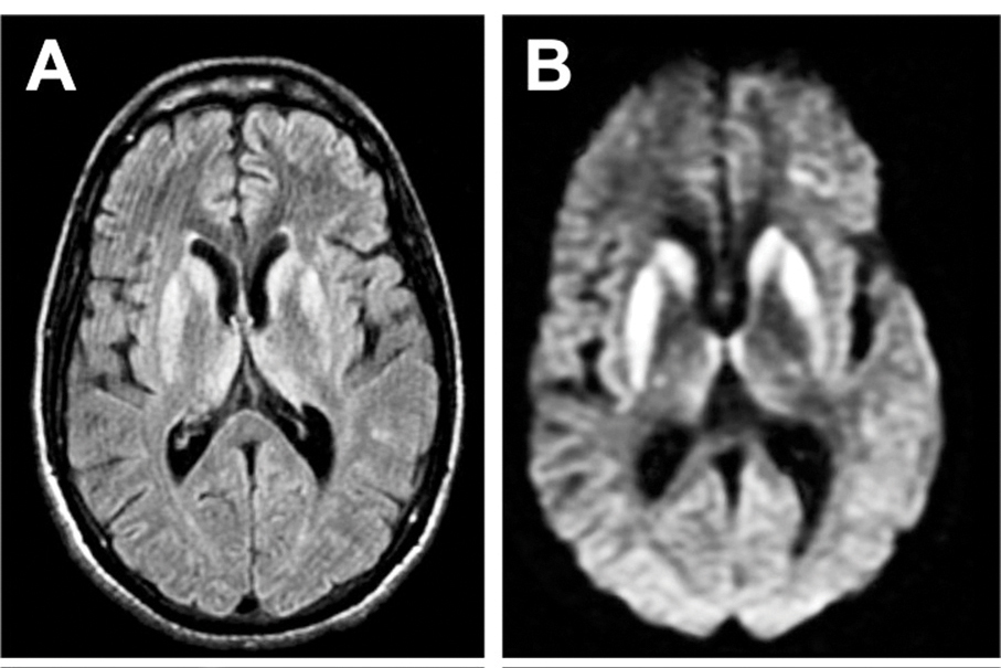Health Bureau logs 2nd sCJD case this year