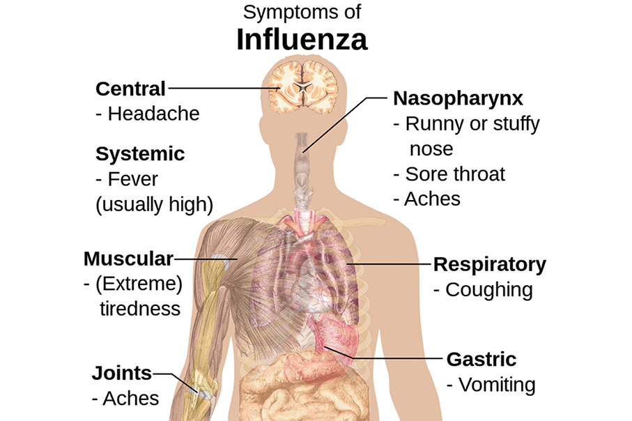 SSM records 1 serious flu case, 3 collective flu cases